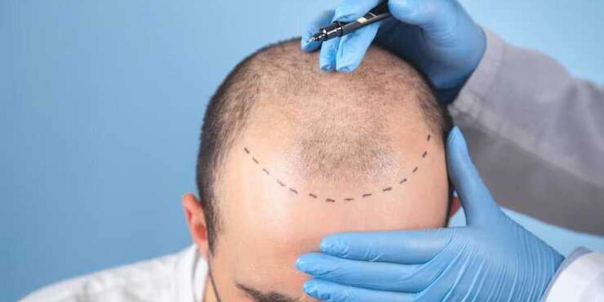 Top Hair Transplant Forehead: A Comprehensive Guide