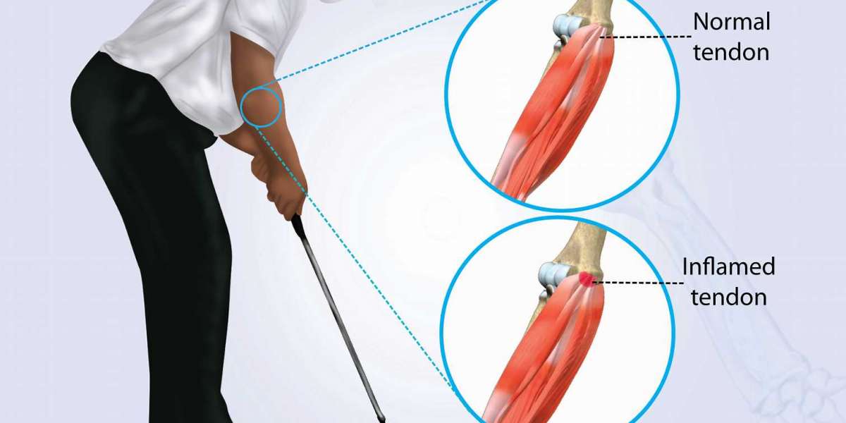How to Use Aspadol 200 to Treat Golfer's Elbow Pain