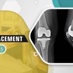 Knee Joint Replacement Profile Picture