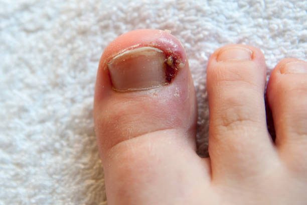 DIY Solutions vs. Doctor Visit: When Can You Treat an Ingrown Toenail at Home