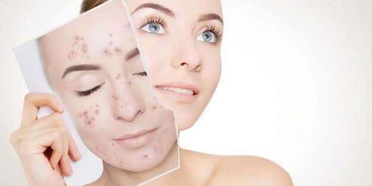 The Top 5 Acne Treatments