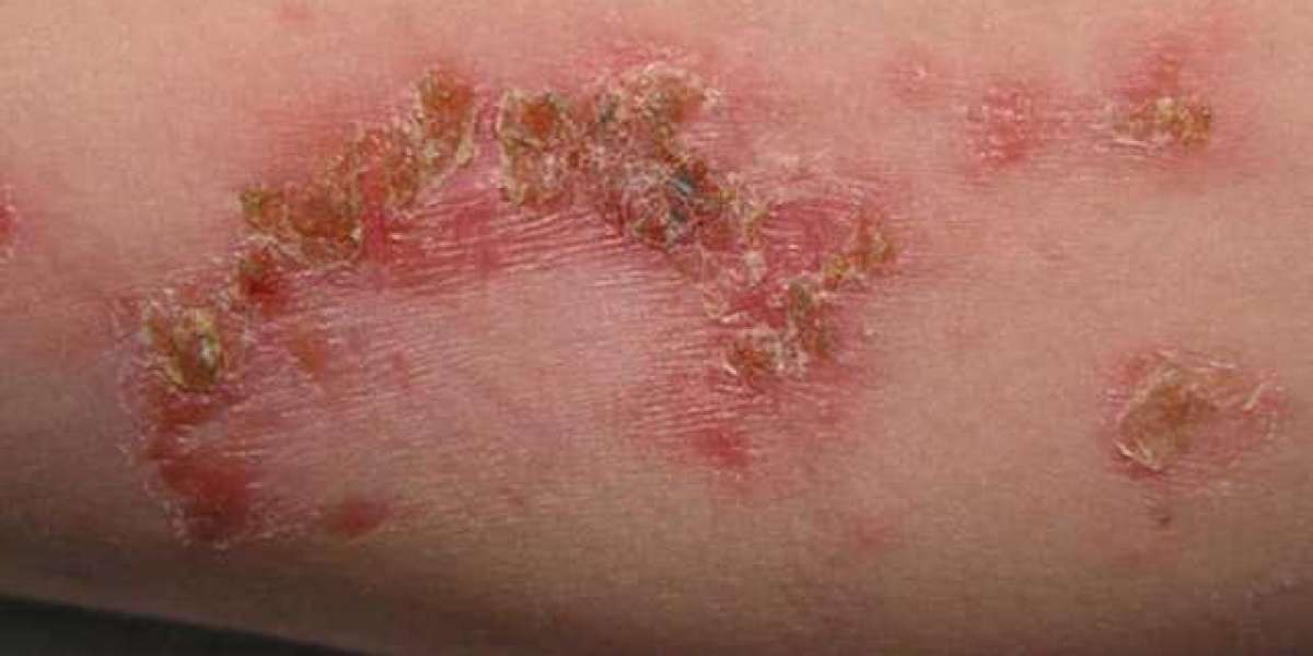 Bacterial Infection of the Skin in Dogs