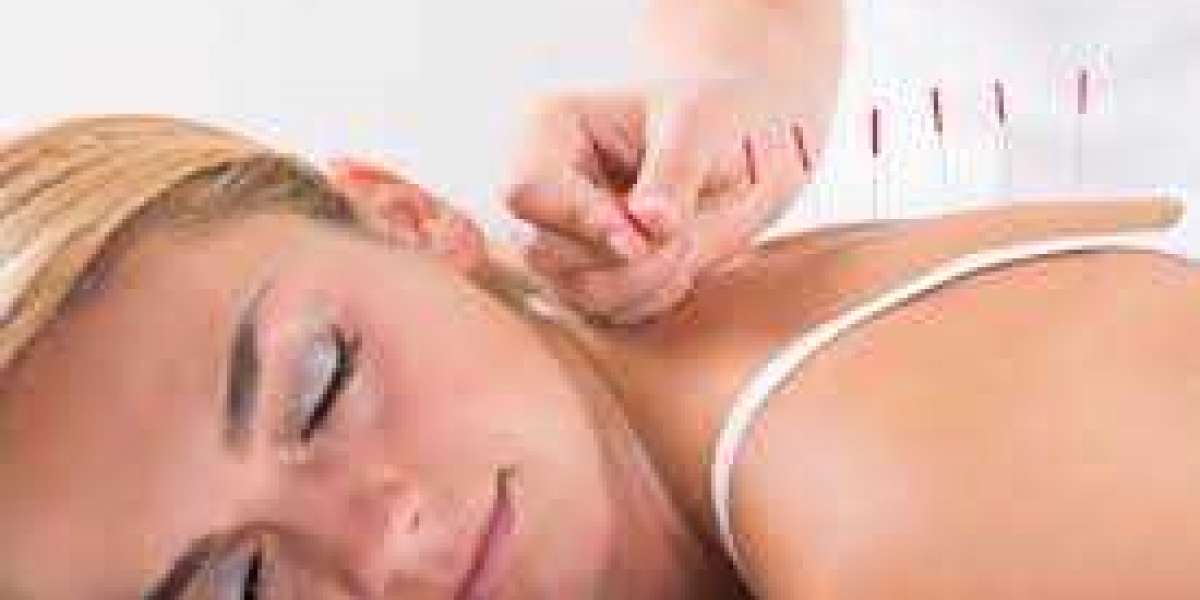 The Benefits of Visiting an Acupuncture Wellness Center